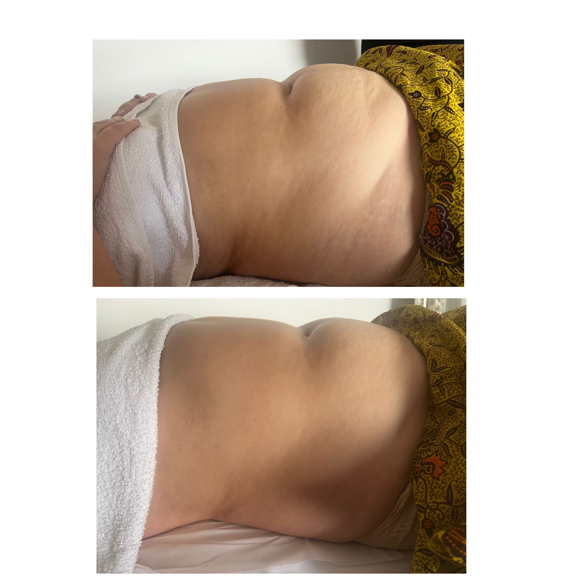 Lymphatic drainage massage before and after — abdomen contouring results after 1 session — Bury Skin, Laser & Wellness Clinic, Bury