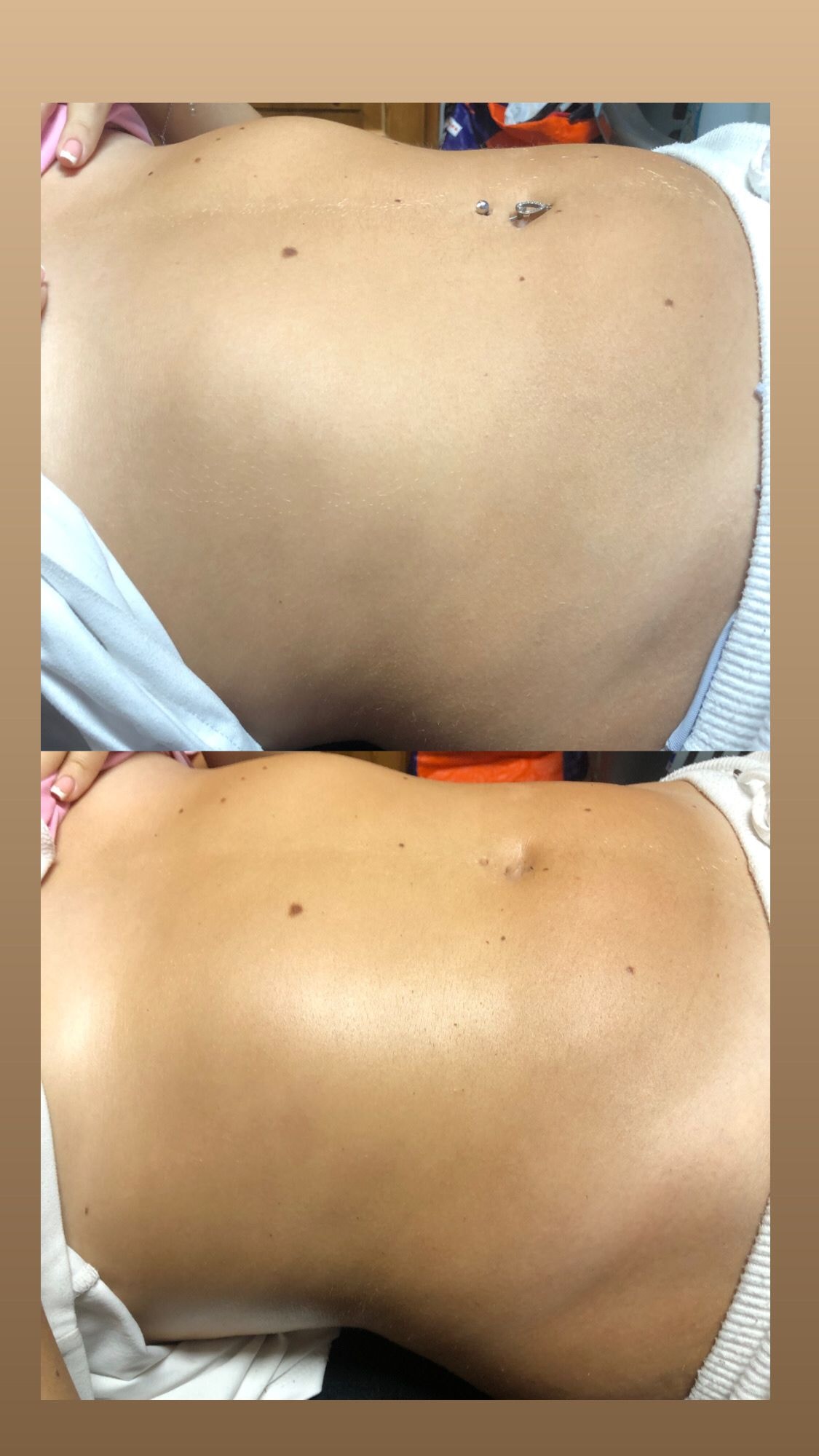 Lymphatic drainage massage before and after — back and shoulder contouring results after 1 session — Bury Skin, Laser & Wellness Clinic, Bury