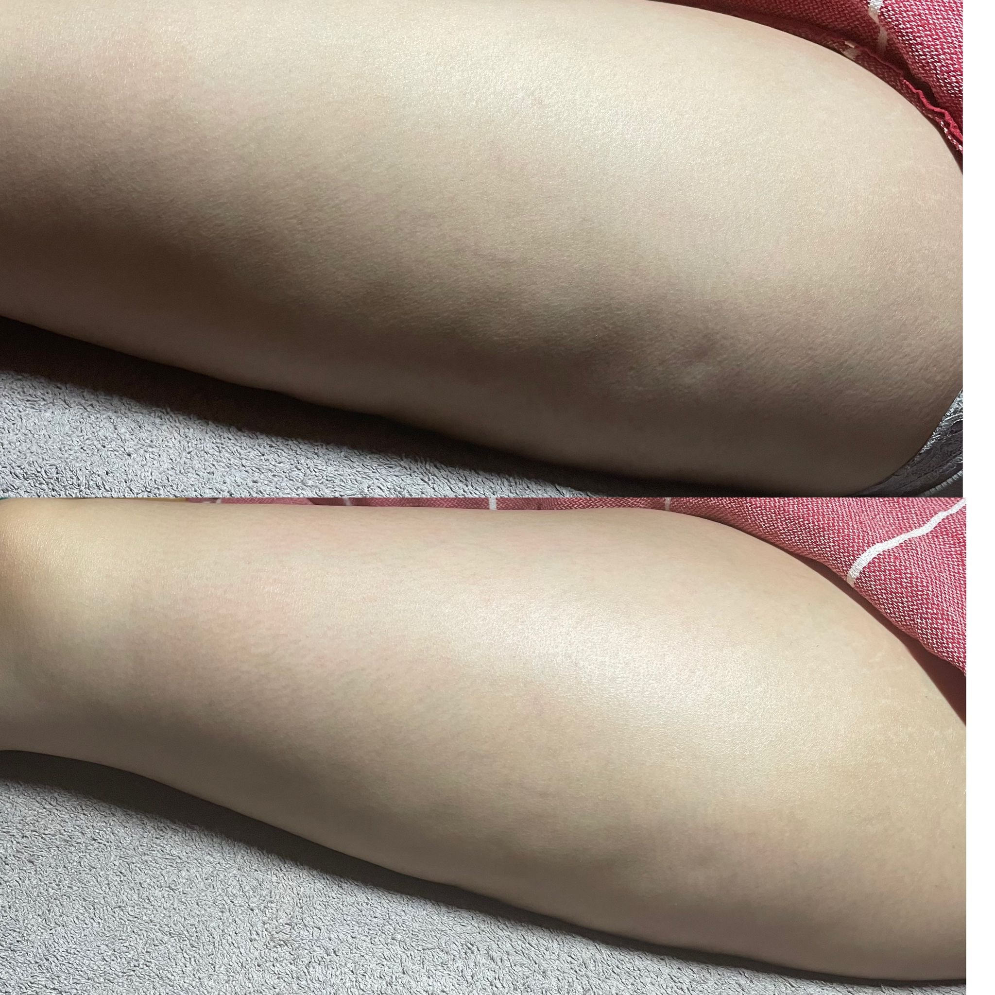 Lymphatic drainage massage before and after — abdomen smoothing and contouring after 1 session — Bury Skin, Laser & Wellness Clinic, Bury