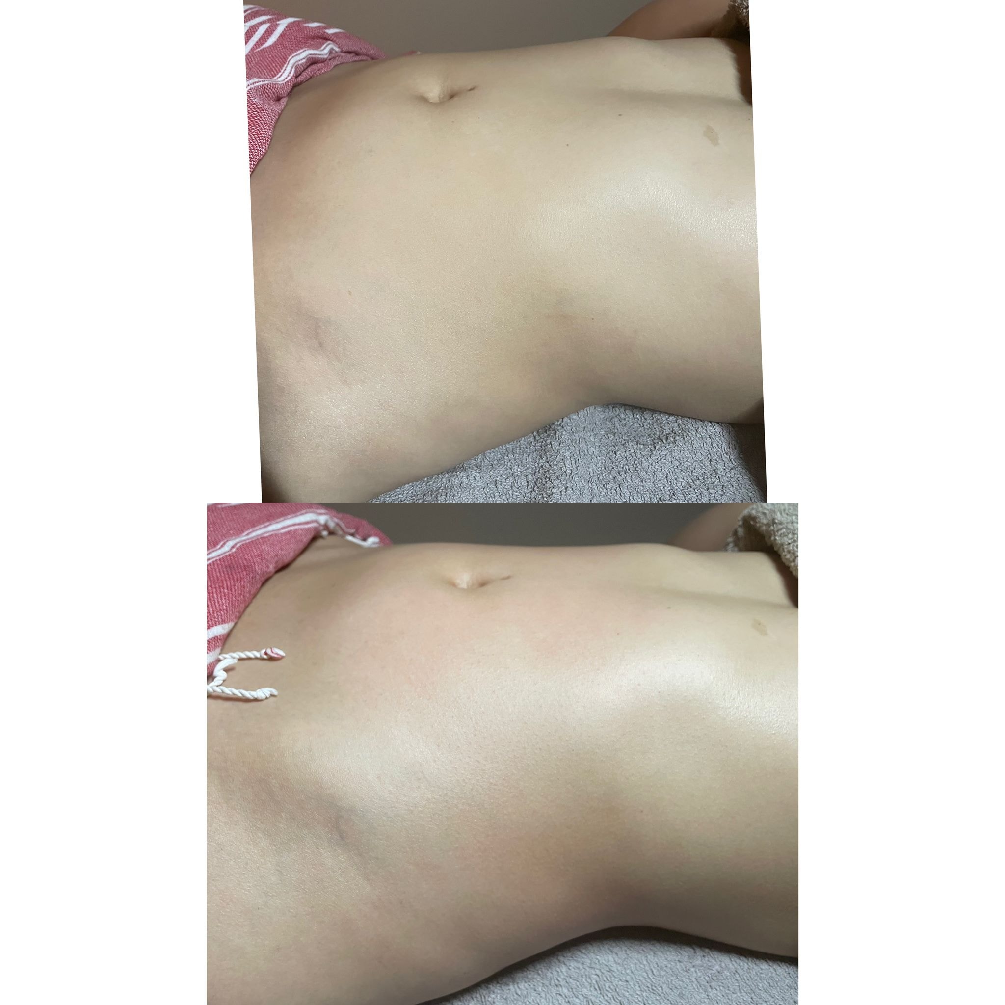 Lymphatic drainage massage before and after — waist and back contouring results after 1 session — Bury Skin, Laser & Wellness Clinic, Bury