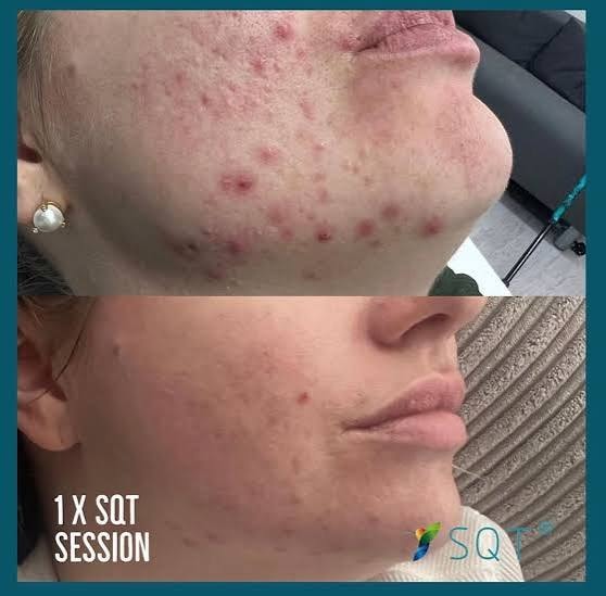 SQT Bio-Microneedling before and after — acne scarring improvement after 1 session — Bury Skin Clinic