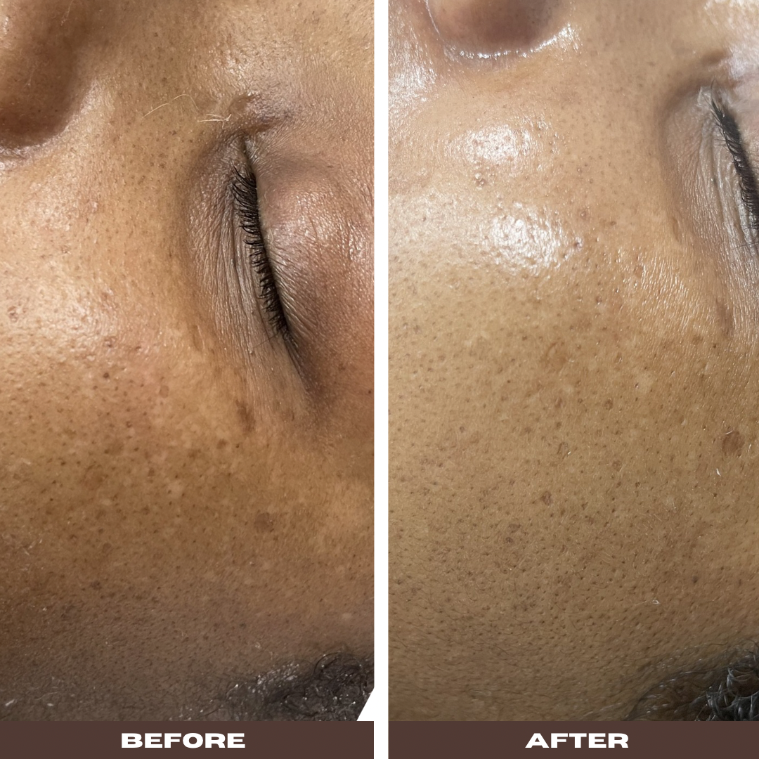 PDRN skin regeneration results — Bury Skin Clinic