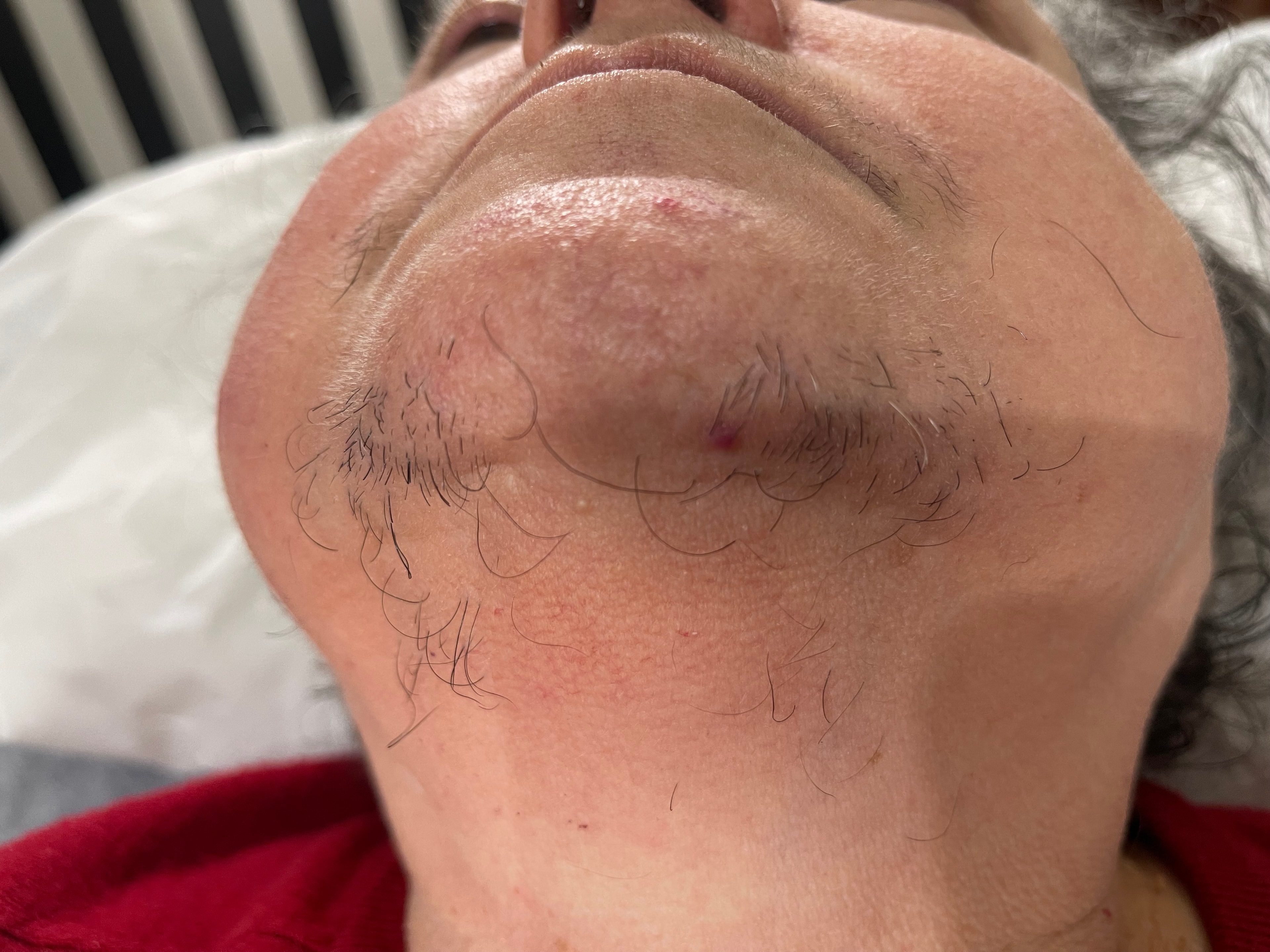Before laser hair removal treatment — chin and jaw area — Bury Skin, Laser & Wellness Clinic, Bury, Greater Manchester